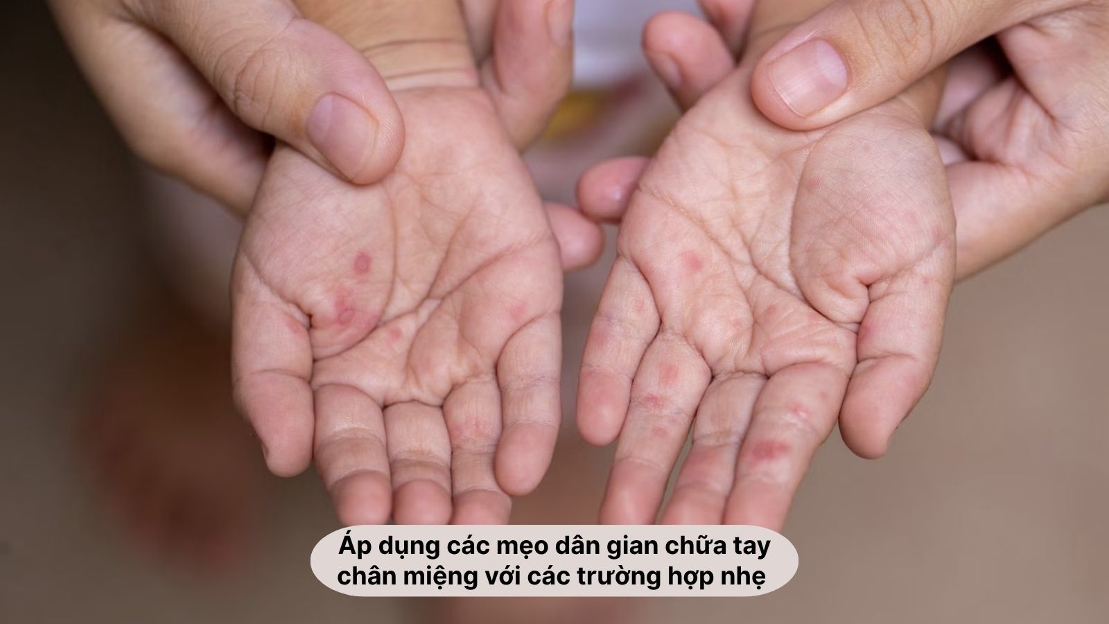 Mẹo d&acirc;n gian chữa bệnh tay ch&acirc;n miệng an to&agrave;n, dễ thực hiện