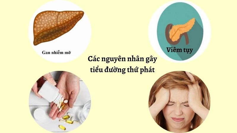Nguy&ecirc;n nh&acirc;n g&acirc;y đ&aacute;i th&aacute;o đường thứ ph&aacute;t