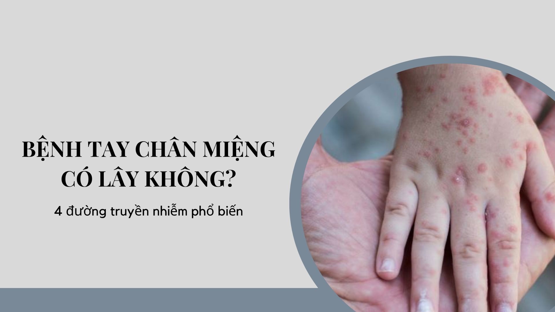Bệnh tay chân miệng có lây không? 4 đường truyền nhiễm phổ biến