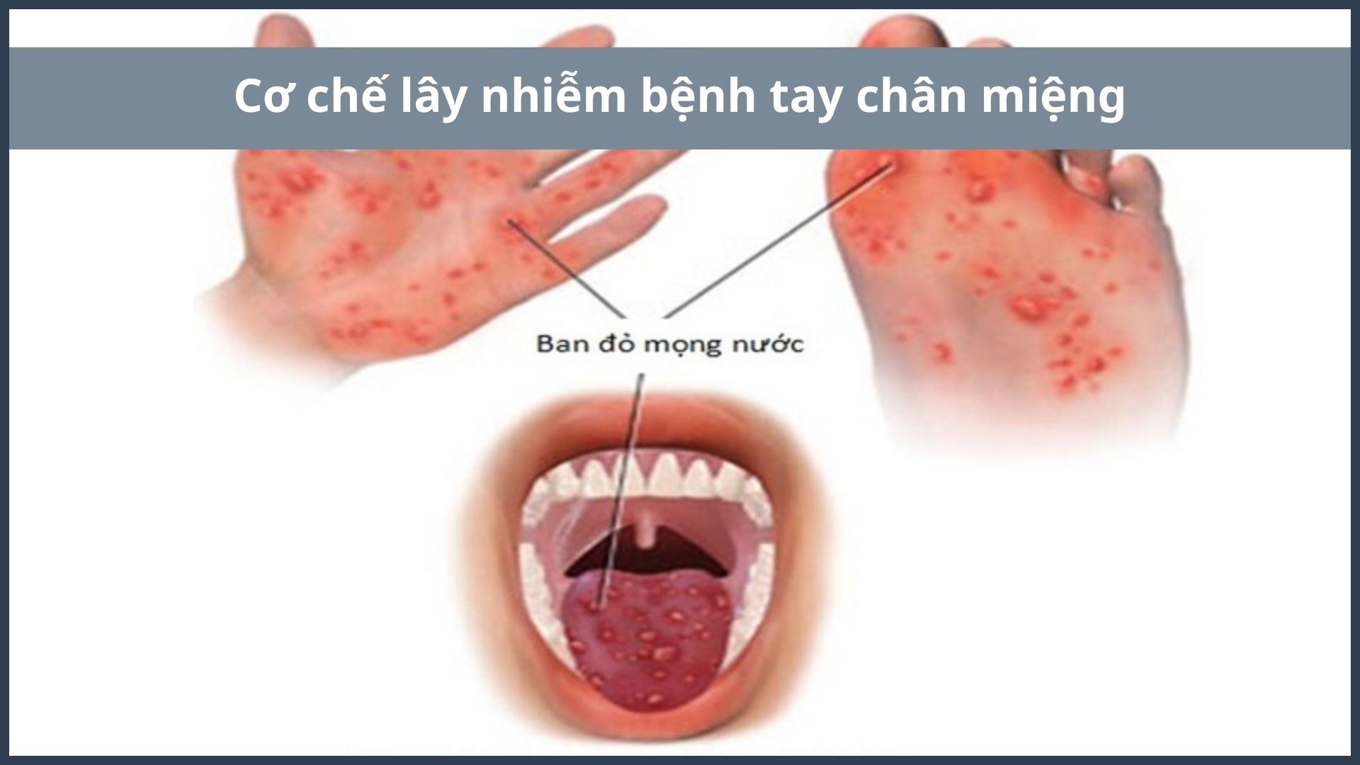 Virus từ c&aacute;c mụn nước dễ ph&aacute;t t&aacute;n v&agrave; l&acirc;y lan cho người kh&aacute;c khi tiếp x&uacute;c