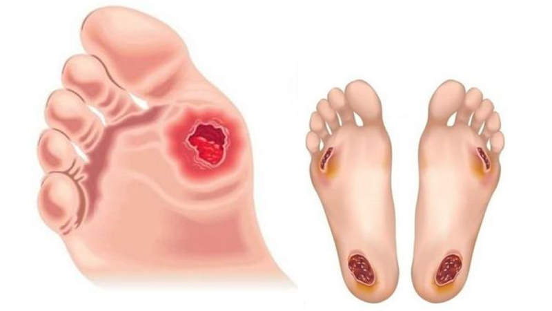 Kiểm tra b&agrave;n ch&acirc;n trước khi ngủ để ngăn ngừa biến chứng nguy hiểm ở tiểu đường