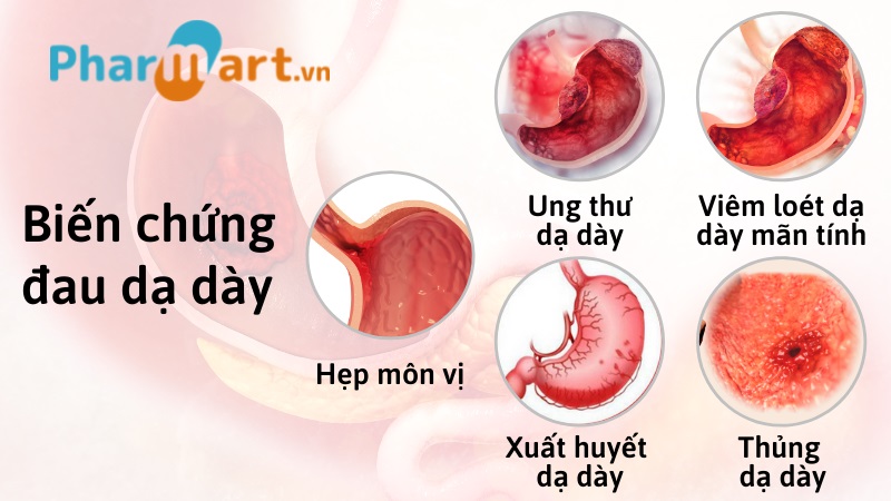 C&aacute;c biến chứng của bệnh đau dạ d&agrave;y