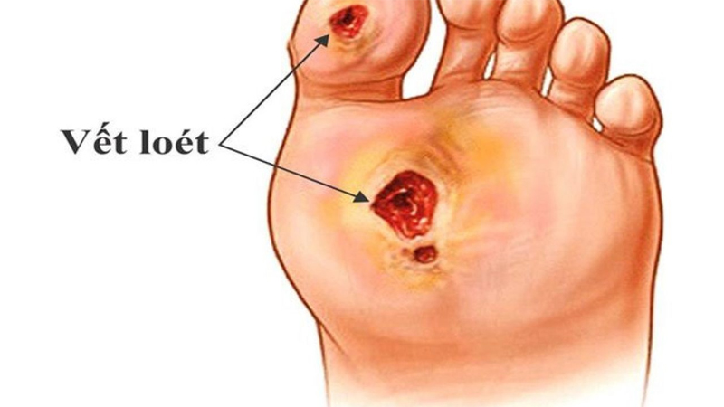 Xuất hiện vết lo&eacute;t l&agrave; biến chứng tiểu đường ở ch&acirc;n