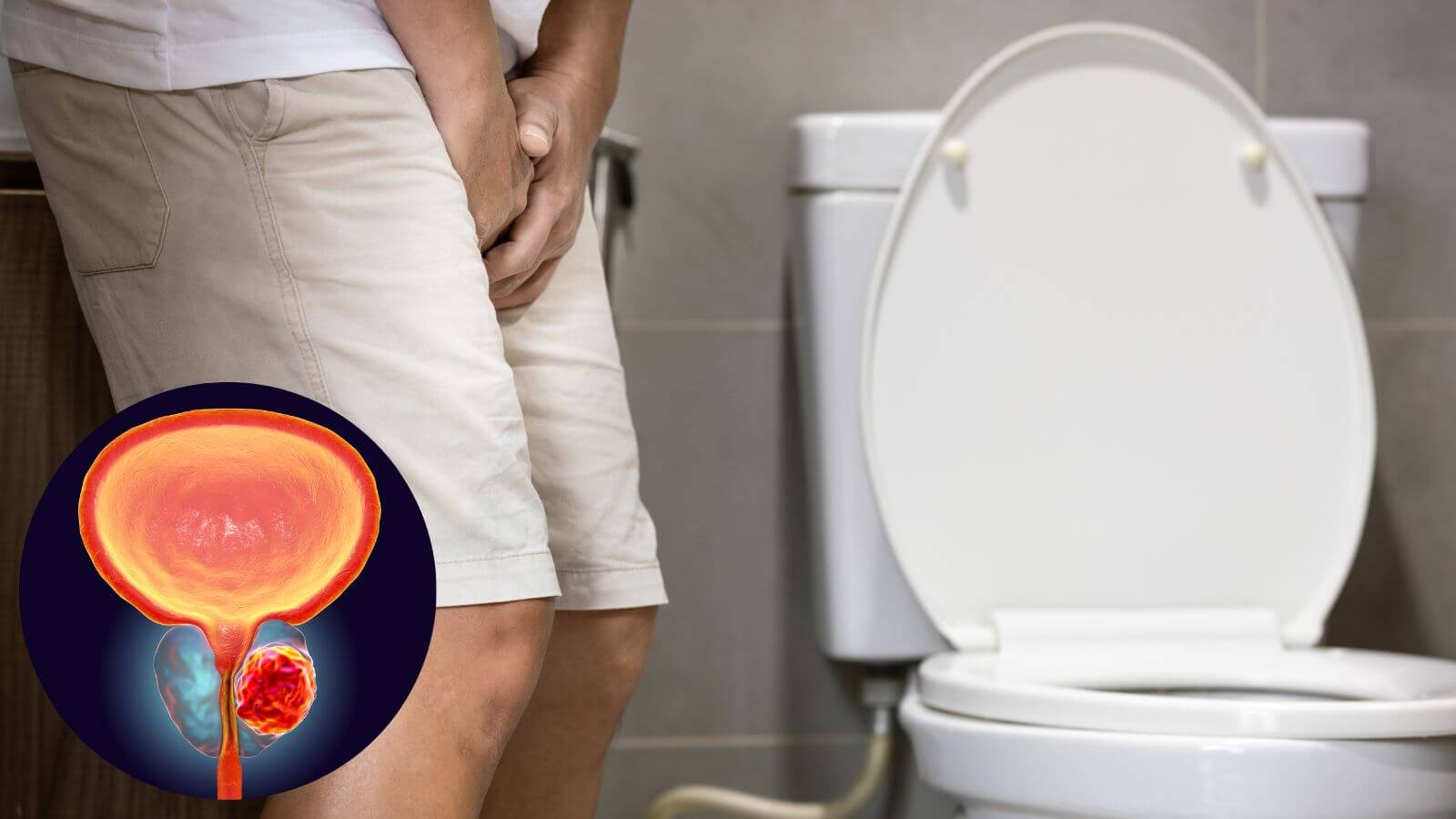 Bất thường khi đi tiểu l&agrave; biểu hiện của bệnh ph&igrave; đại tuyến tiền liệt