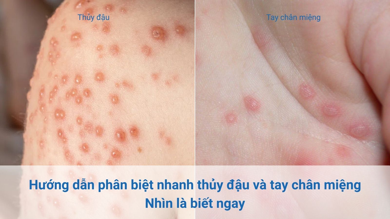 Cần ph&acirc;n biệt thủy đậu v&agrave; tay ch&acirc;n miệng l&agrave; hai bệnh kh&aacute;c nhau
