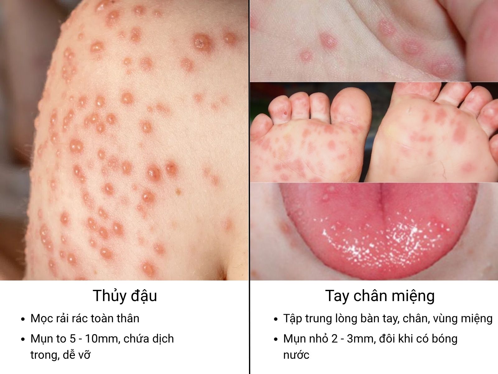 Sự kh&aacute;c biệt giữa mụn thủy đậu v&agrave; tay ch&acirc;n miệng