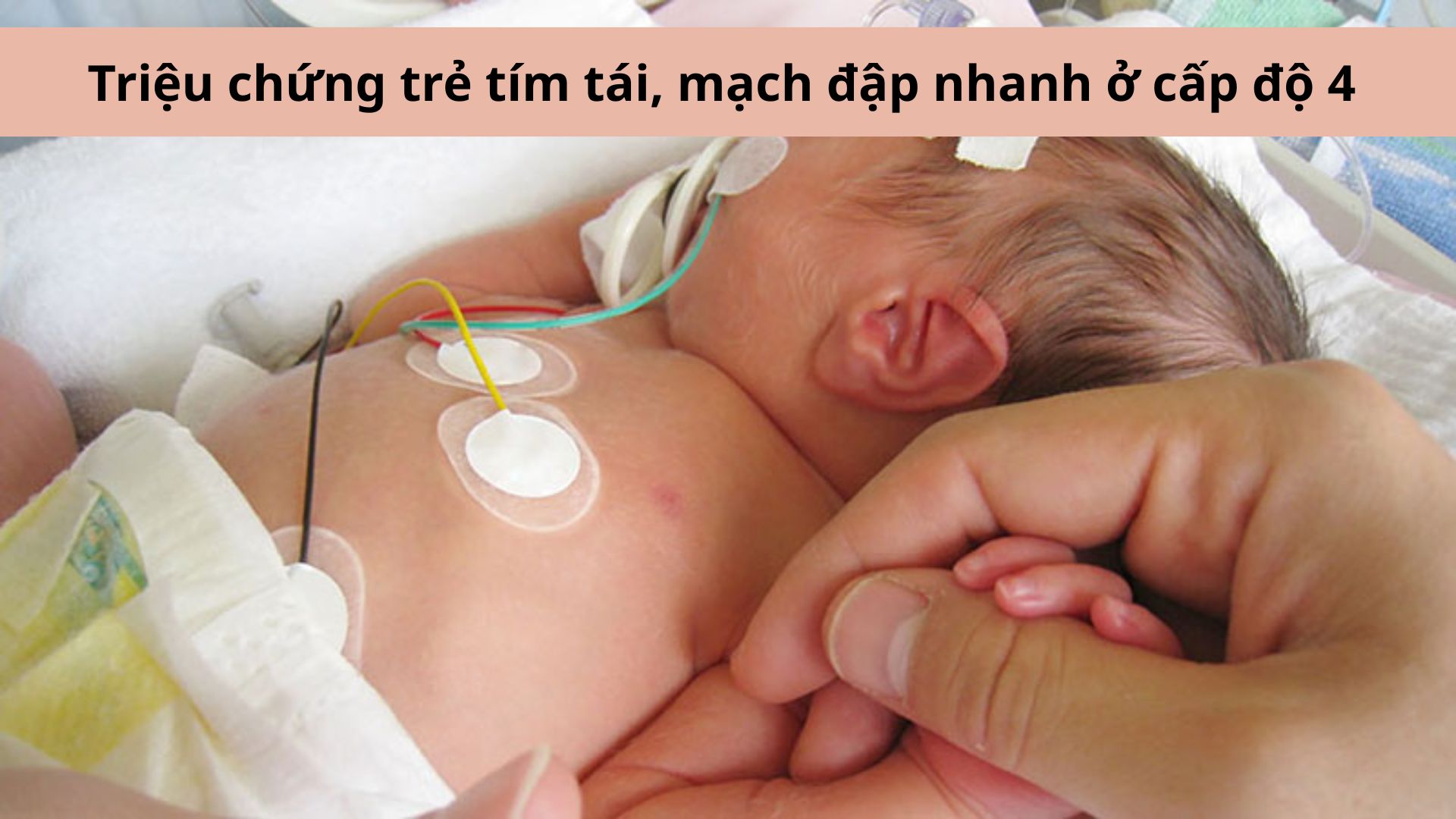 Trẻ bị t&iacute;m t&aacute;i, mạch đập nhanh l&agrave; dấu hiệu tay ch&acirc;n miệng cấp độ 4
