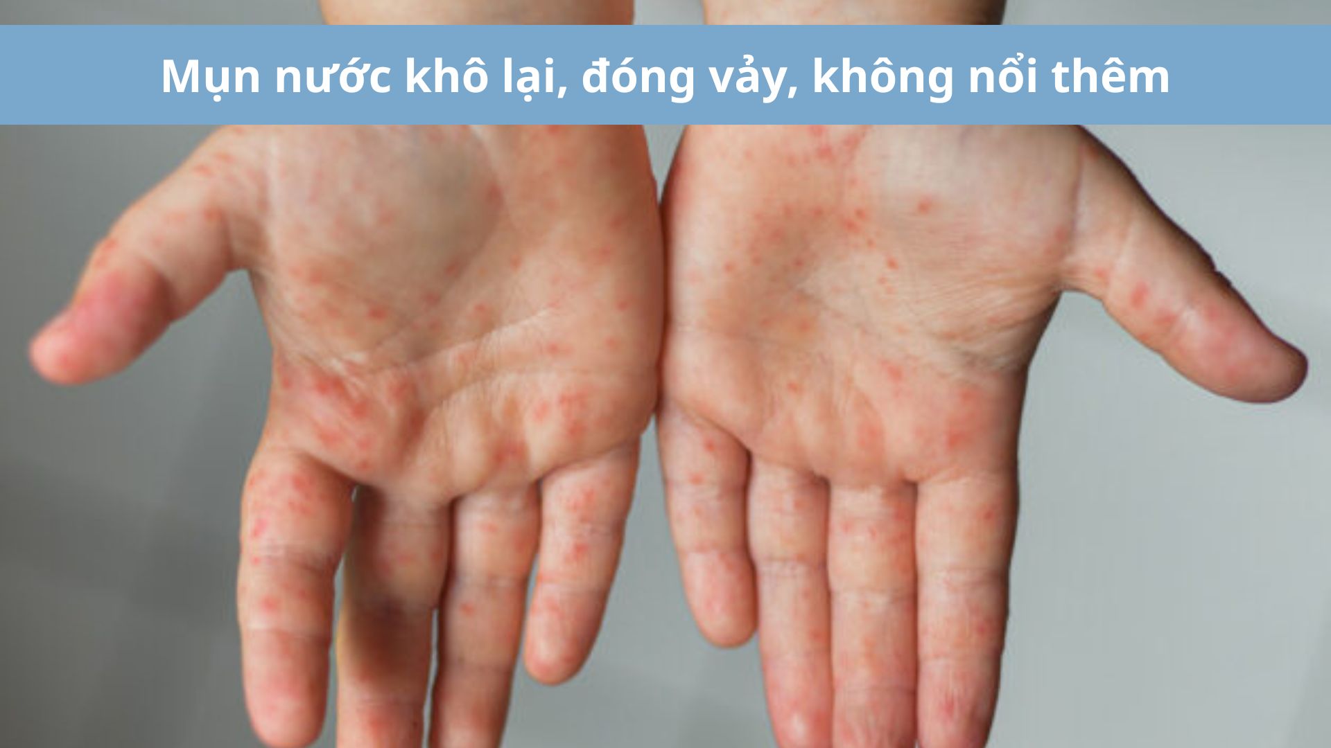 7 Dấu hiệu khỏi bệnh tay ch&acirc;n miệng - Mụn nước bắt đầu kh&ocirc; lại, kh&ocirc;ng nổi th&ecirc;m