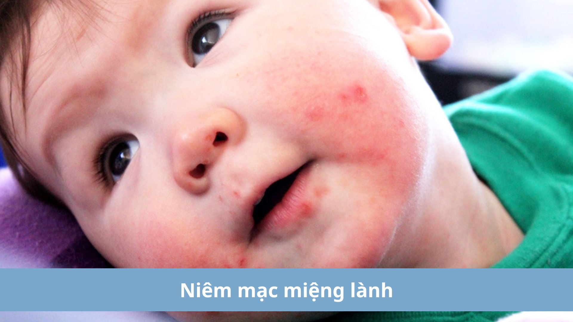 Ni&ecirc;m mạc họng ở trẻ dần l&agrave;nh lại l&agrave; dấu hiệu bệnh đang thuy&ecirc;n giảm