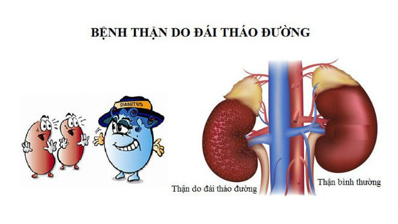 Tiểu đường type 2 c&oacute; thể g&acirc;y n&ecirc;n c&aacute;c biến chứng về thận