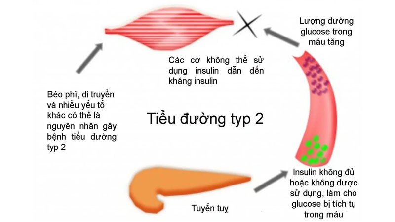 đ&aacute;i th&aacute;o đường type 2