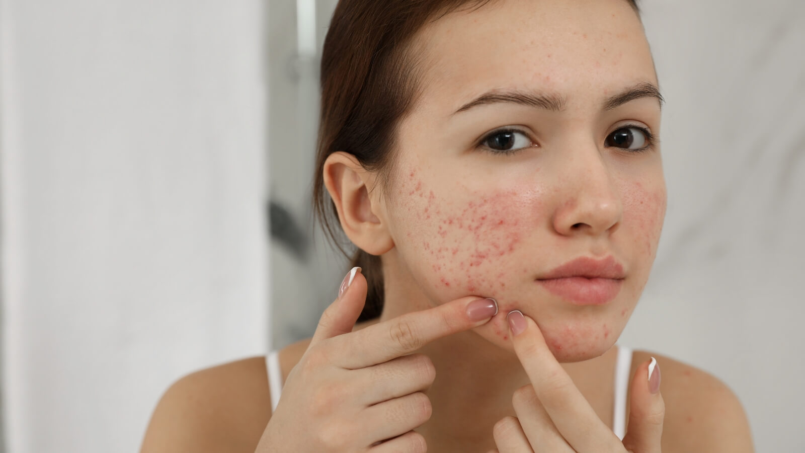 Da nổi mụn v&agrave; xỉn m&agrave;u l&agrave; một dấu hiệu gan đang th&agrave;i độc