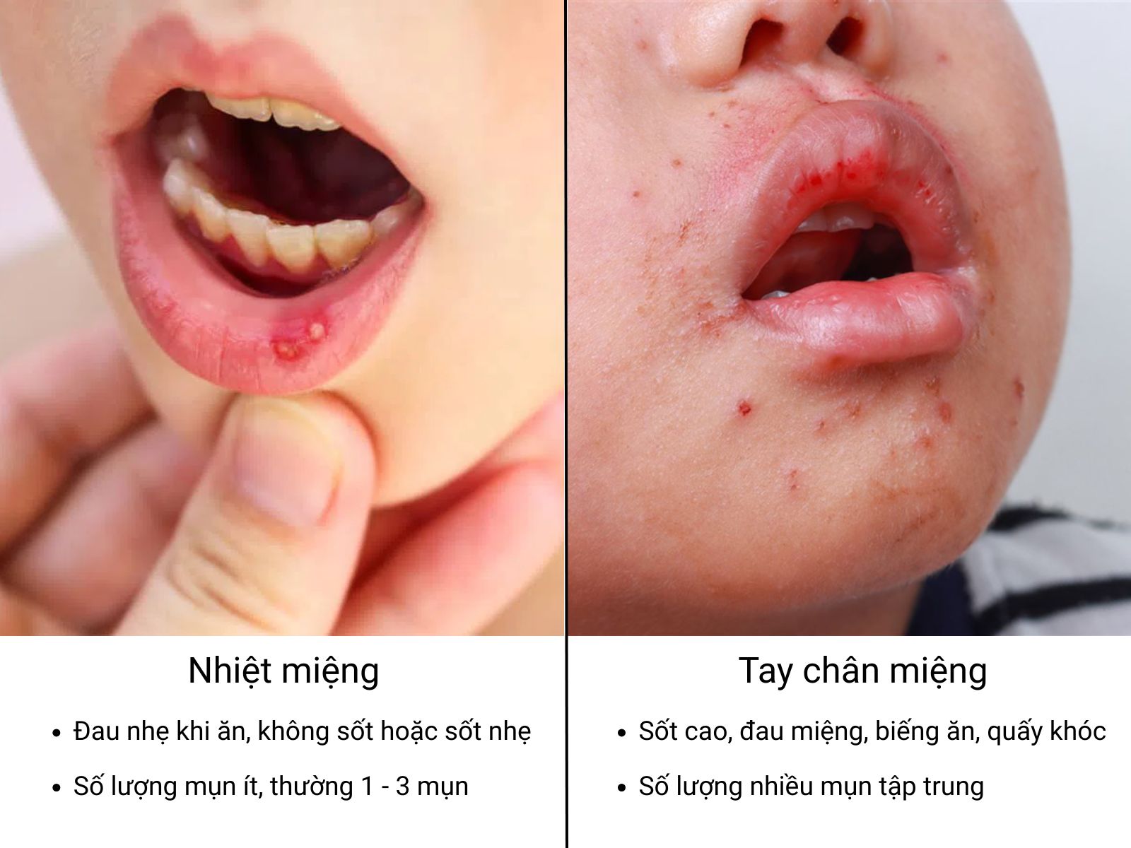 Cả tay ch&acirc;n miệng v&agrave; nhiệt miệng đều g&acirc;y cảm gi&aacute;c kh&oacute; chịu khi ăn uống