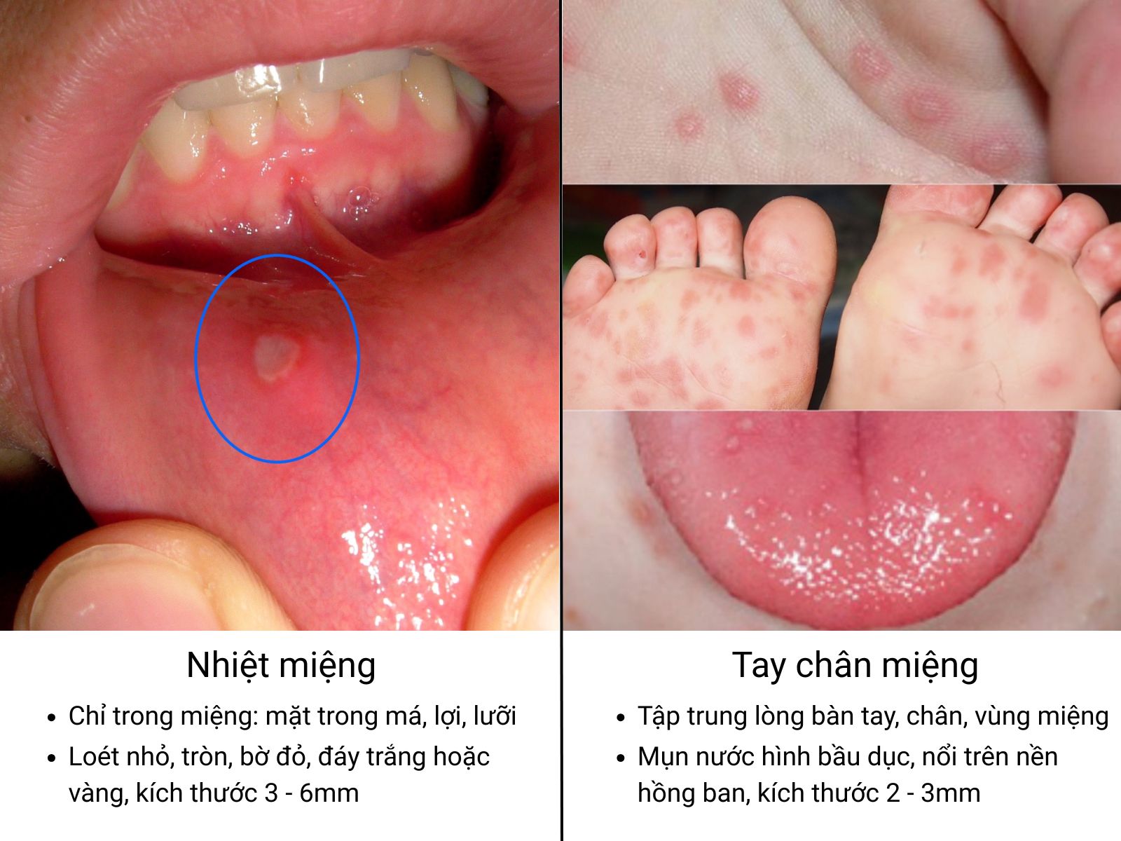 Ba mẹ c&oacute; thể quan s&aacute;t kỹ c&aacute;c đặc điểm mụn để ph&acirc;n biệt nhiệt miệng v&agrave; tay ch&acirc;n miệng