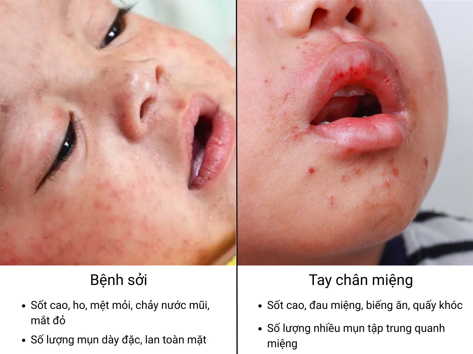 Kh&aacute;c với sởi, bệnh tay ch&acirc;n miệng chỉ nổi mụn nước quanh miệng, tay ch&acirc;n