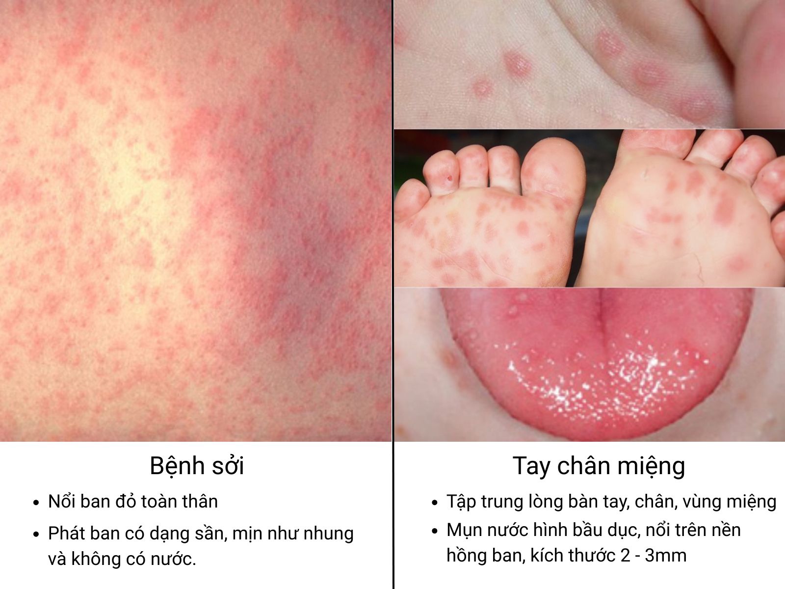 Nh&igrave;n nốt mụn ba mẹ c&oacute; thể ph&acirc;n biệt sởi v&agrave; tay ch&acirc;n miệng