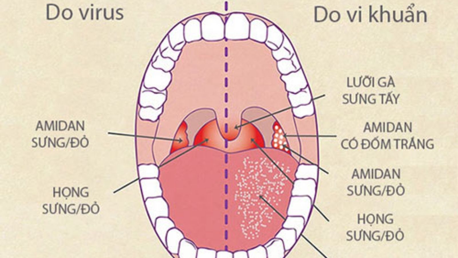 Triệu chứng vi&ecirc;m họng do virus v&agrave; vi khuẩn c&oacute; sự kh&aacute;c nhau