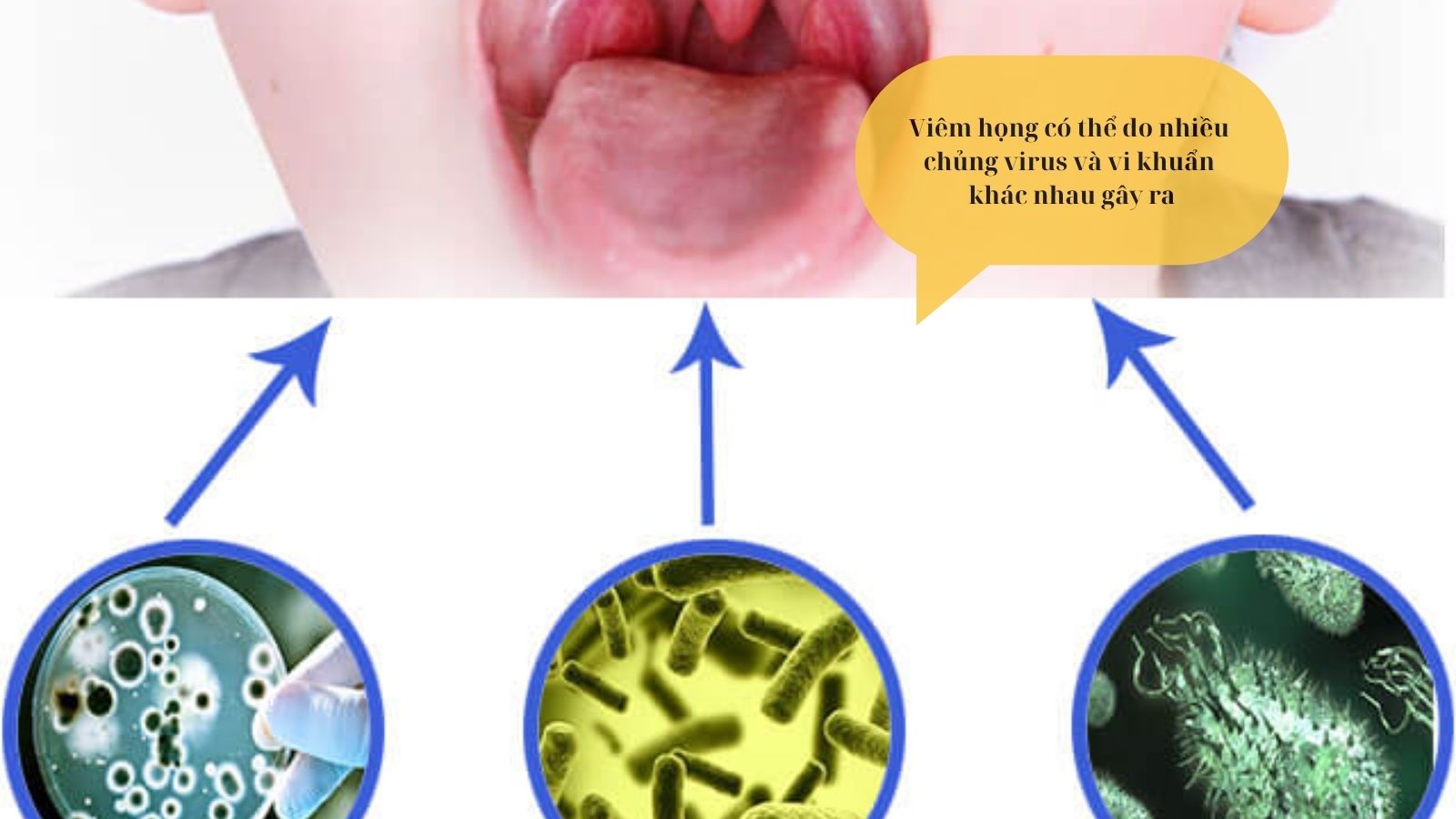 Vi&ecirc;m họng c&oacute; thể do nhiều chủng virus v&agrave; vi khuẩn kh&aacute;c nhau g&acirc;y ra.