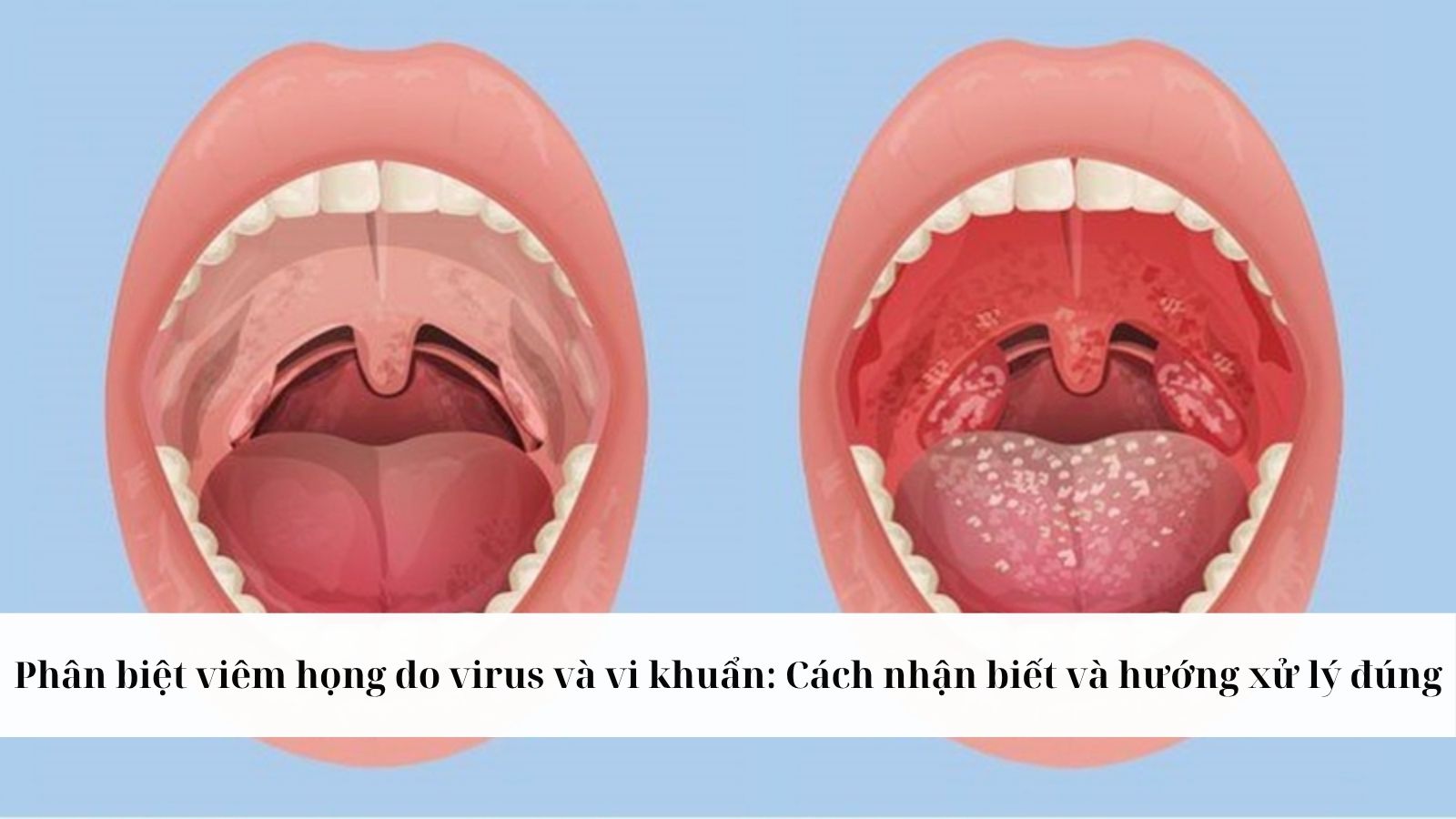 Phân biệt viêm họng do virus và Trang chủ đăng nhập HZ88 không chặn tặng 88K: Cách nhận biết và hướng xử lý đúng