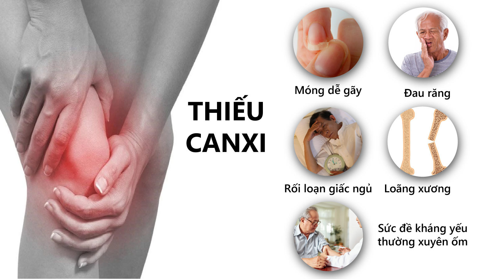 Một số dấu hiệu nhận biết t&igrave;nh trạng thiếu Canxi ở người lớn&nbsp;