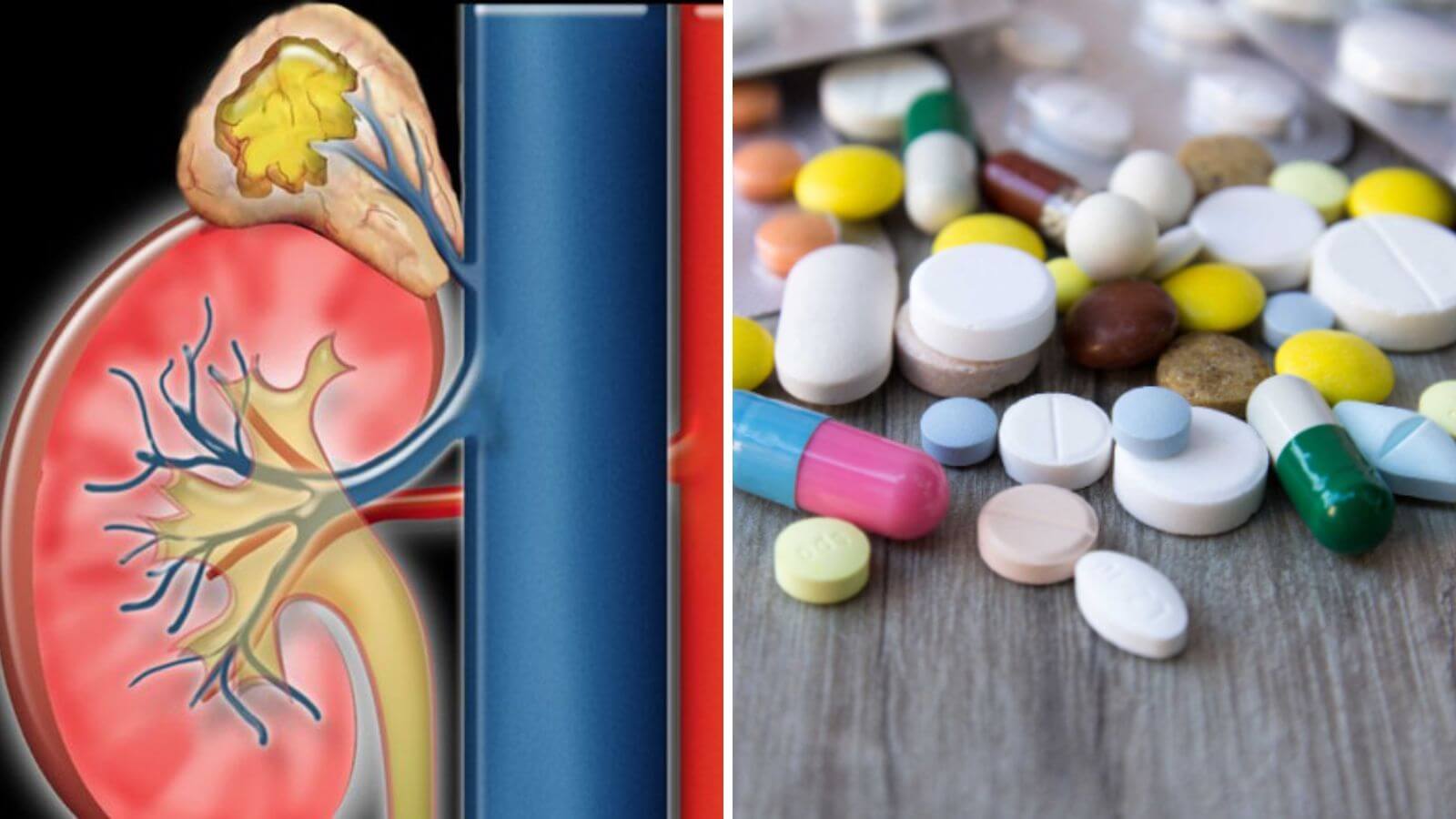 Testosterone cao c&oacute; thể do bệnh l&yacute; hoặc lạm dụng thuốc
