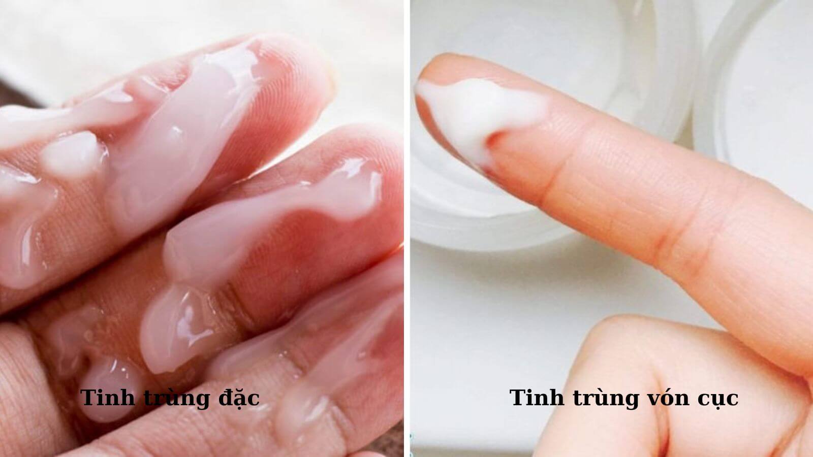Ph&acirc;n biệt tinh tr&ugrave;ng đặc v&agrave; tinh tr&ugrave;ng v&oacute;n cục