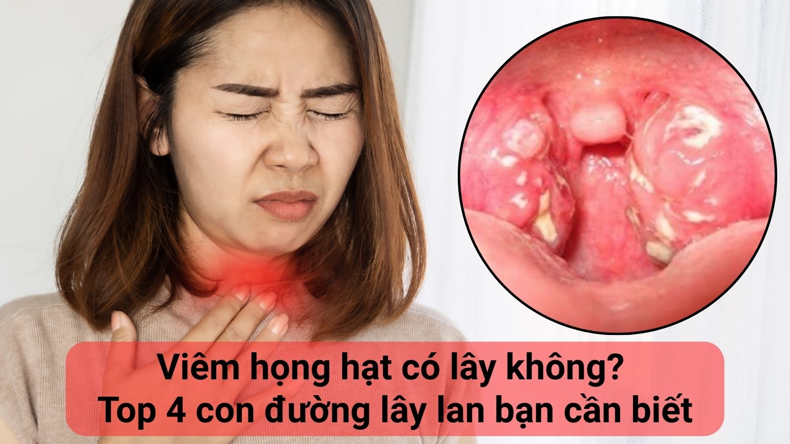 Vi&ecirc;m họng hạt c&oacute; l&acirc;y kh&ocirc;ng? L&acirc;y theo con đường n&agrave;o?
