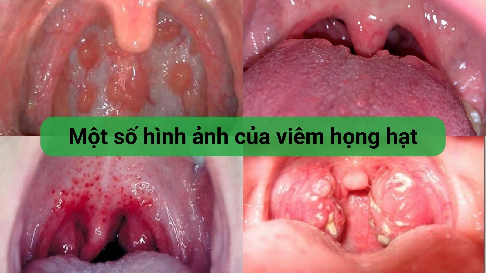 H&igrave;nh ảnh v&ograve;m họng của bệnh nh&acirc;n bị vi&ecirc;m họng hạt