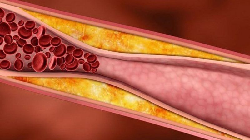 Xơ vữa mạch m&aacute;u l&agrave; một trong những biến chứng tiểu đường g&acirc;y suy giảm tuổi thọ.