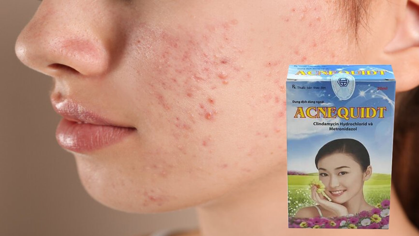&nbsp;AcneQuidt - Điều trị mụn trứng c&aacute;