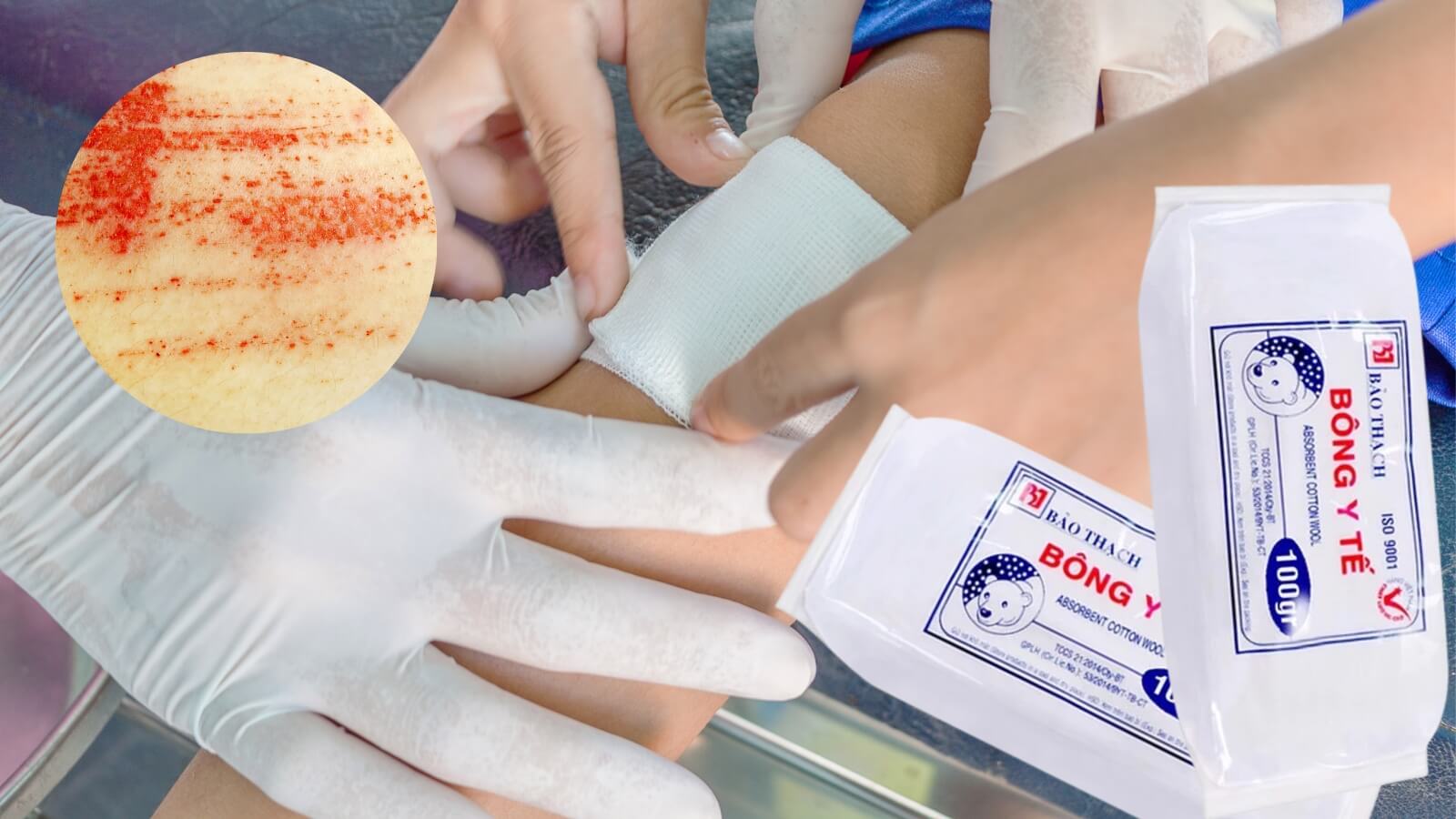 B&ocirc;ng y tế Bảo Thạch d&ugrave;ng để thấm m&aacute;u, cầm m&aacute;u hay s&aacute;t tr&ugrave;ng vết thương.