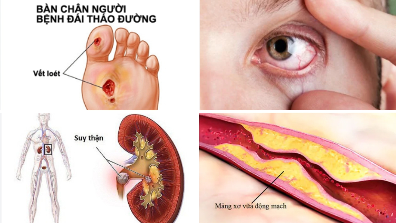 Một số biến chứng của bệnh đ&aacute;i th&aacute;i đường
