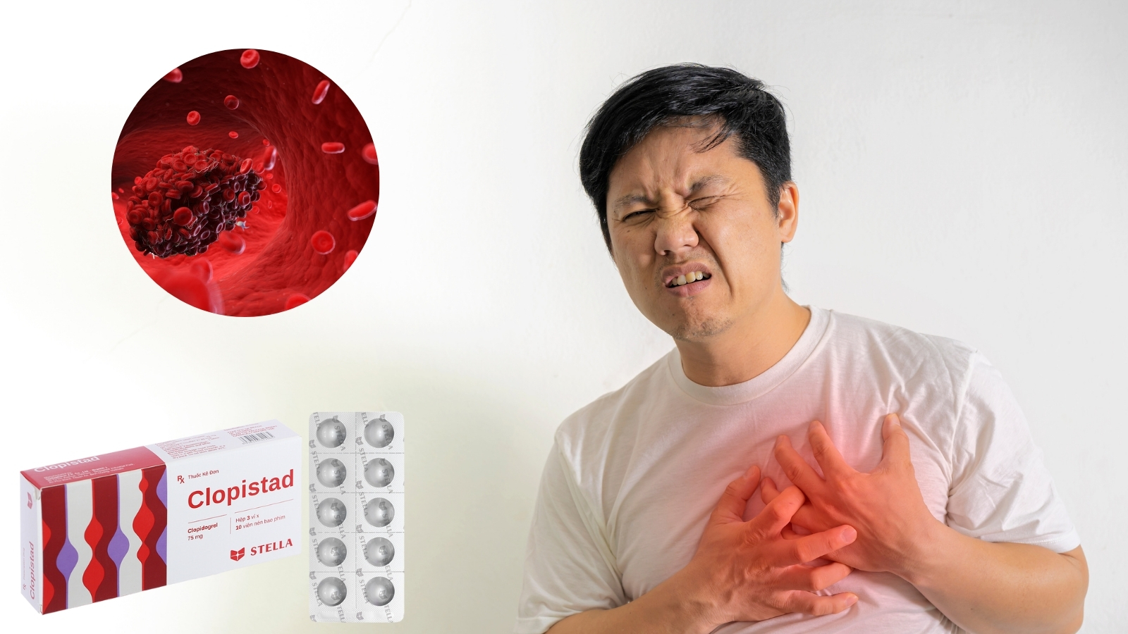 Clopidogrel l&agrave; một loại thuốc thuộc nh&oacute;m thuốc chống kết tập tiểu cầu.