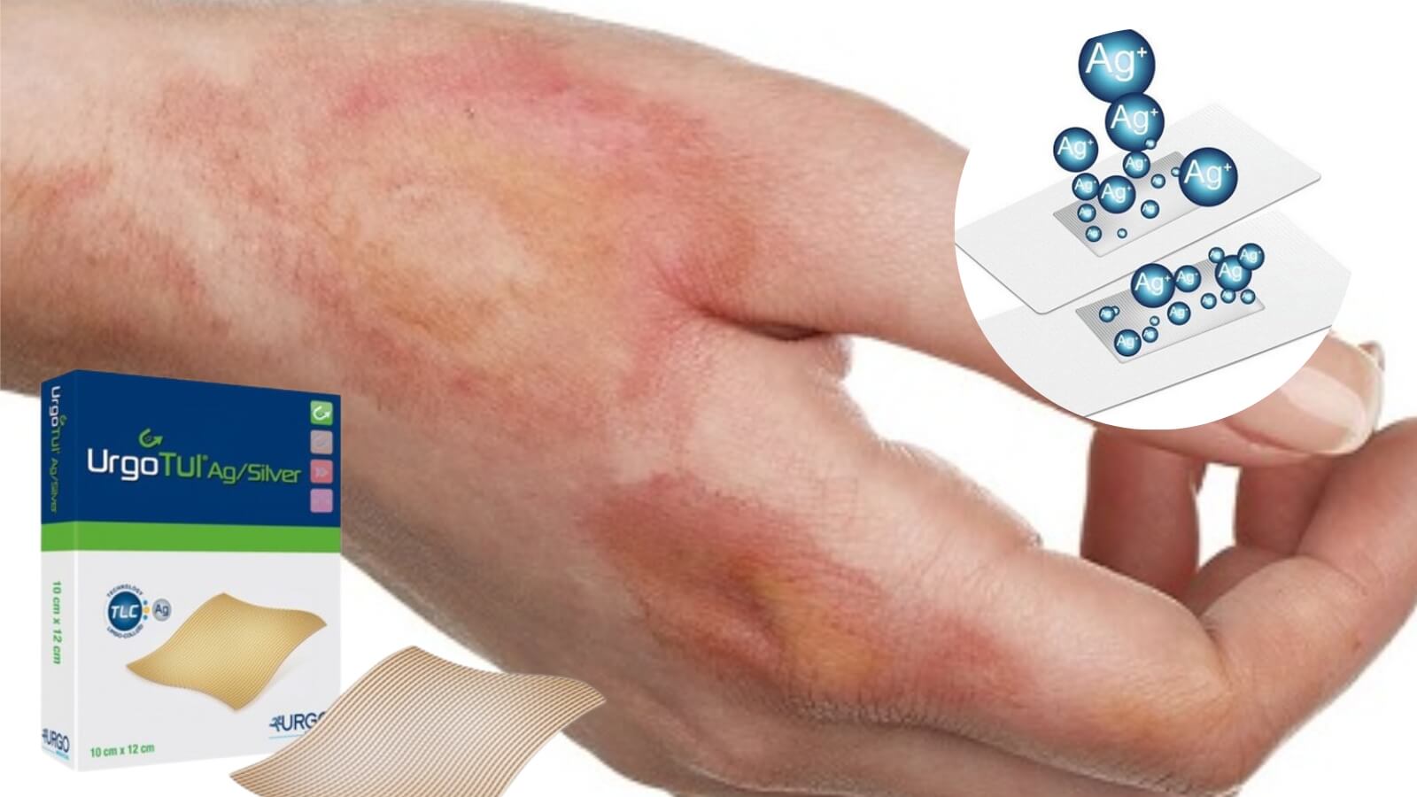 C&aacute;c ion bạc của Urgotul Ag/Silver c&oacute; hoạt t&iacute;nh kh&aacute;ng khuẩn gi&uacute;p giảm nhiễm khuẩn tại chỗ