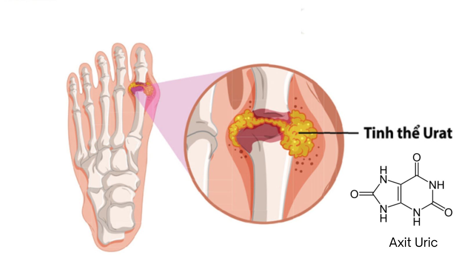 Tinh thể urat h&igrave;nh th&agrave;nh v&agrave; lắng đọng tại xương khớp g&acirc;y ra g&uacute;t