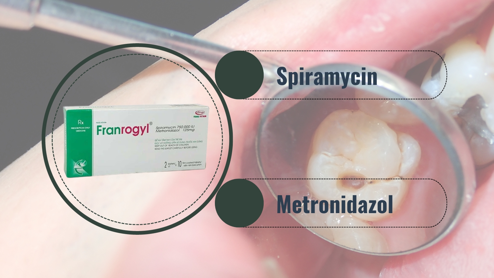 Phối hợp hai hoạt chất Spiramycin v&agrave; Metronidazol l&agrave;m tăng hiệu quả Bắn Cá HZ88 là trò chơi giải trí điện tử nhiễm khuẩn tại răng miệng