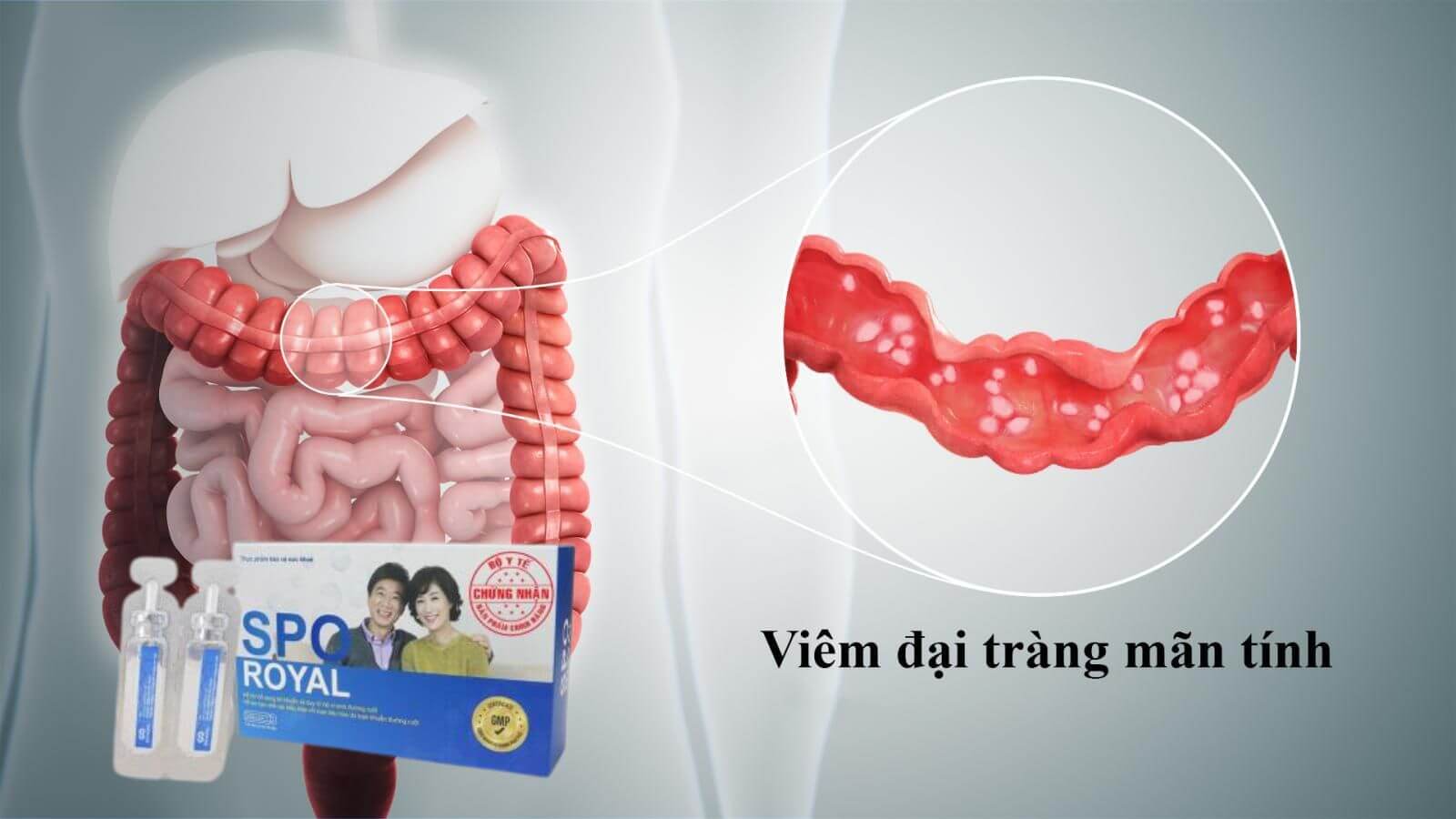 Men ti&ecirc;u h&oacute;a Spo Royal B&agrave;o tử lợi khuẩn cho người vi&ecirc;m đại tr&agrave;ng