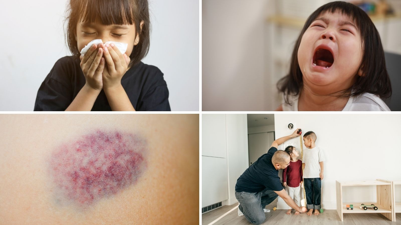 Một số dấu hiệu thường gặp khi thiếu vitamin kho&aacute;ng chất ở trẻ nhỏ 