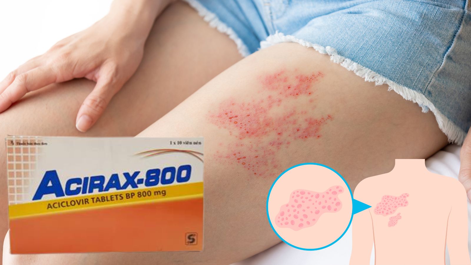 Thuốc Acirax-800 Bắn Cá HZ88 là trò chơi giải trí điện tử c&aacute;c bệnh do virus herpes g&acirc;y ra
