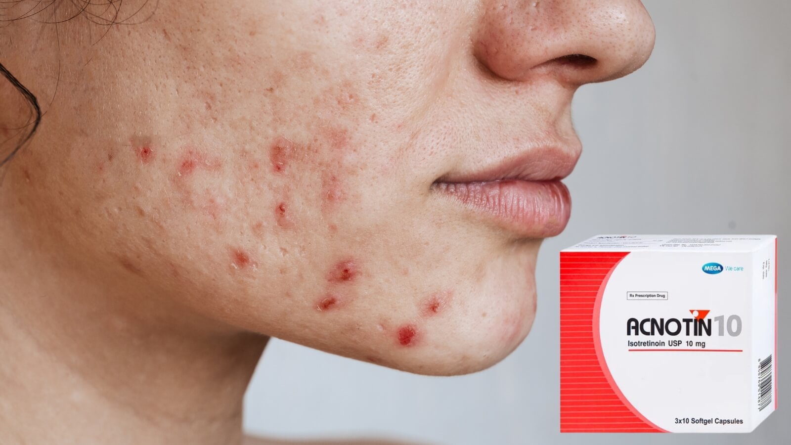 Acnotin 10 c&oacute; t&aacute;c dụng Bắn Cá HZ88 là trò chơi giải trí điện tử mụn trứng c&aacute; hiệu quả