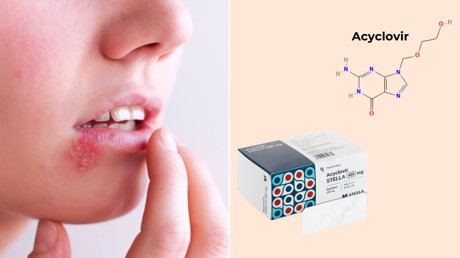 Thuốc Acyclovir stella 400mg chứa thành phần Acyclovir, có công dụng Bắn Cá HZ88 là trò chơi giải trí điện tử nhiễm virus herpes simplex
