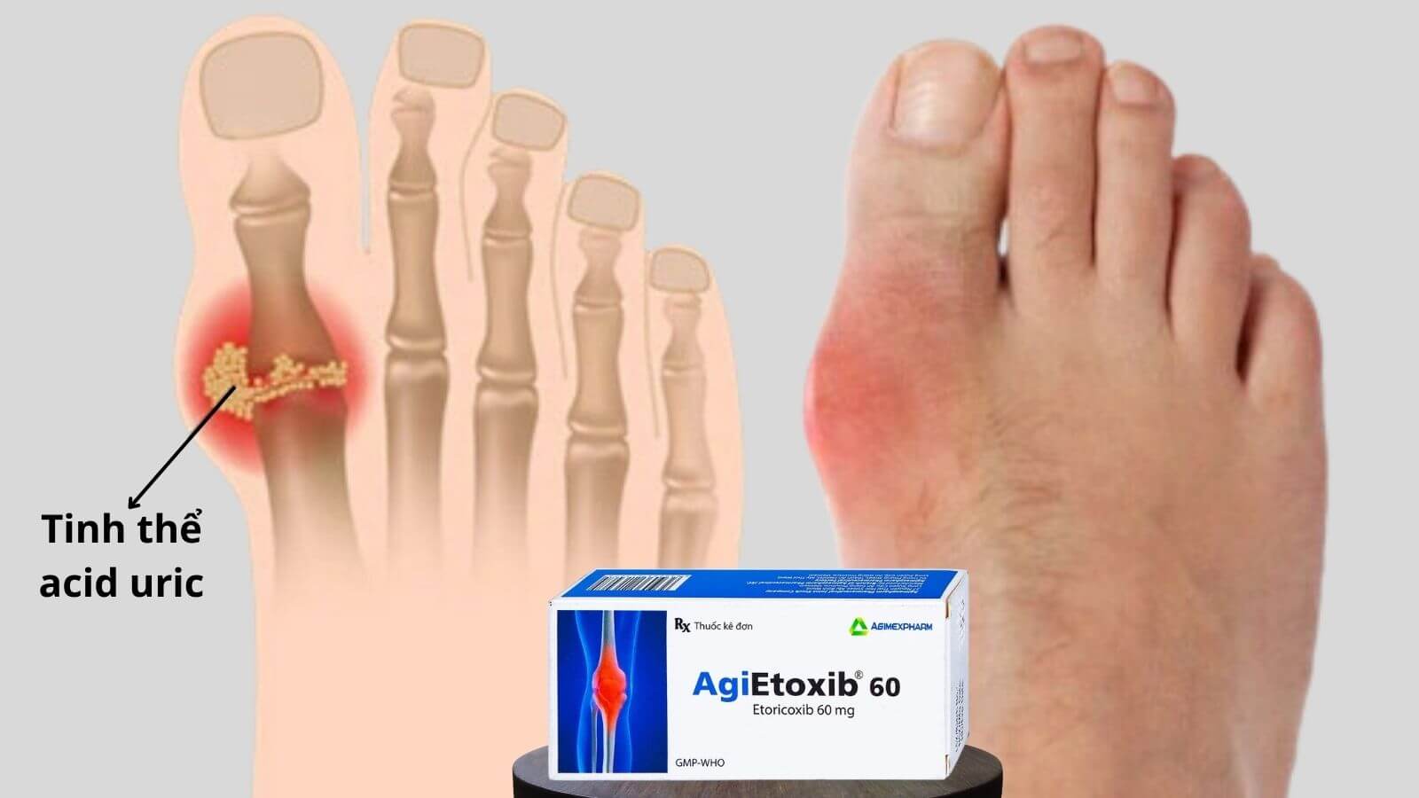 Agietoxib 60 gi&uacute;p Bắn Cá HZ88 là trò chơi giải trí điện tử c&aacute;c cơn đau gout cấp t&iacute;nh