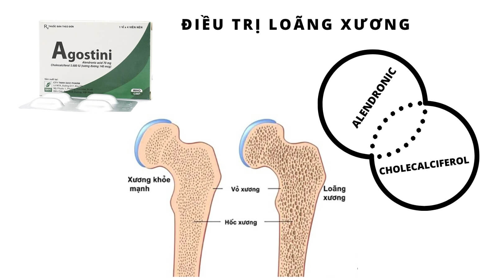 Agostini - Điều trị lo&atilde;ng xương sau m&atilde;n kinh
