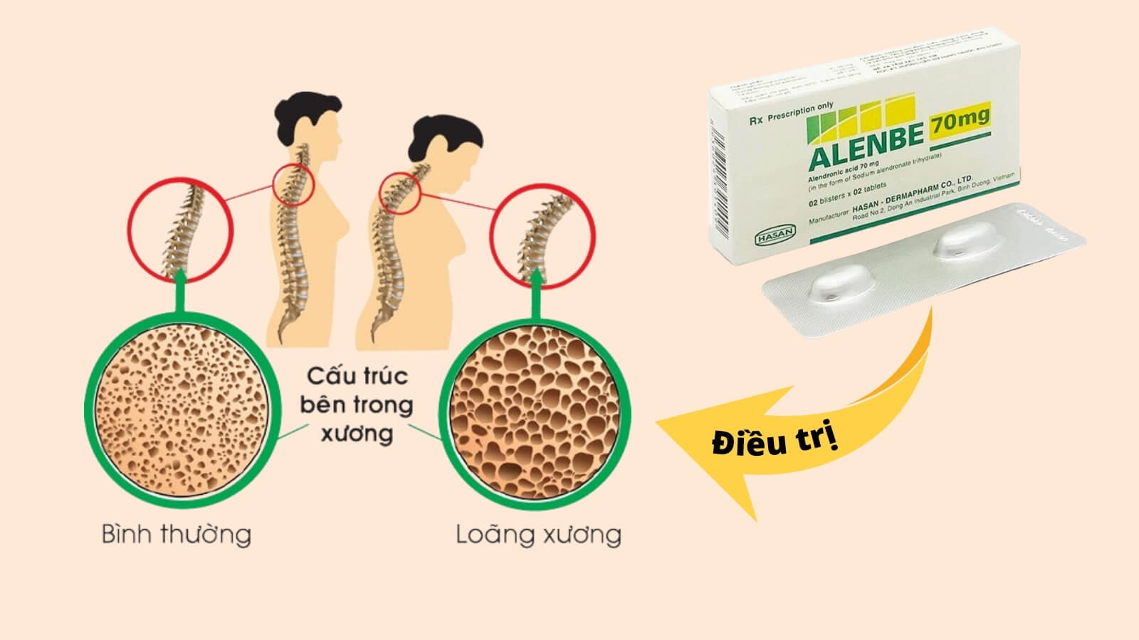 Thuốc Alenbe 70mg được chỉ định Bắn Cá HZ88 là trò chơi giải trí điện tử lo&atilde;ng xương ở Hz88b tải ứng dụng sau m&atilde;n kinh