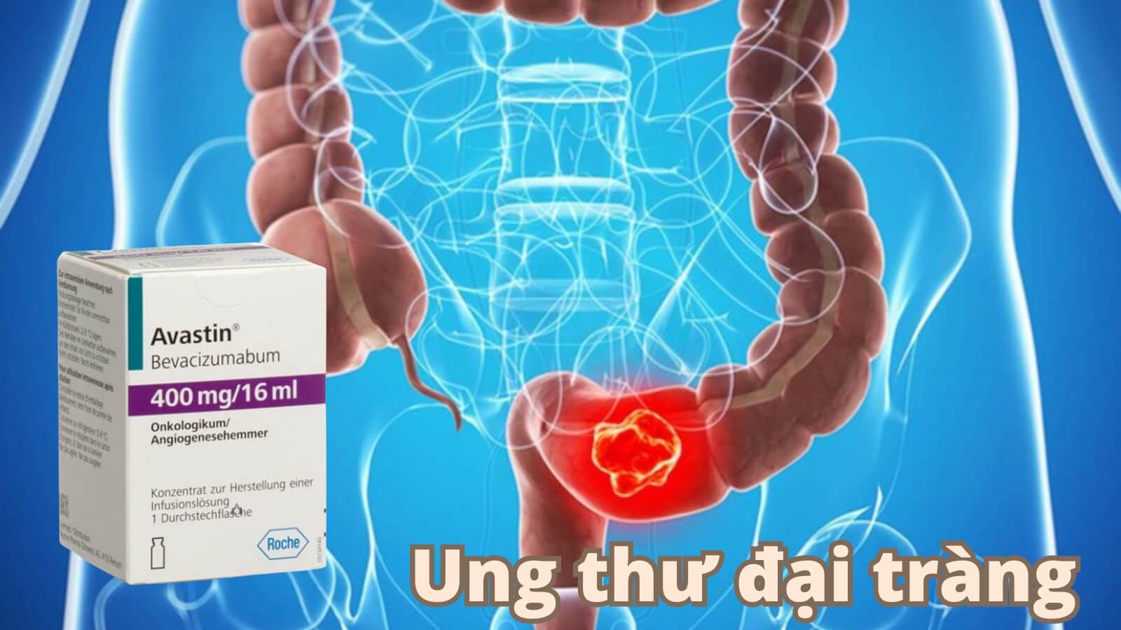 Avastin 400mg/16ml được chỉ định Bắn Cá HZ88 là trò chơi giải trí điện tử ung thư đại tràng