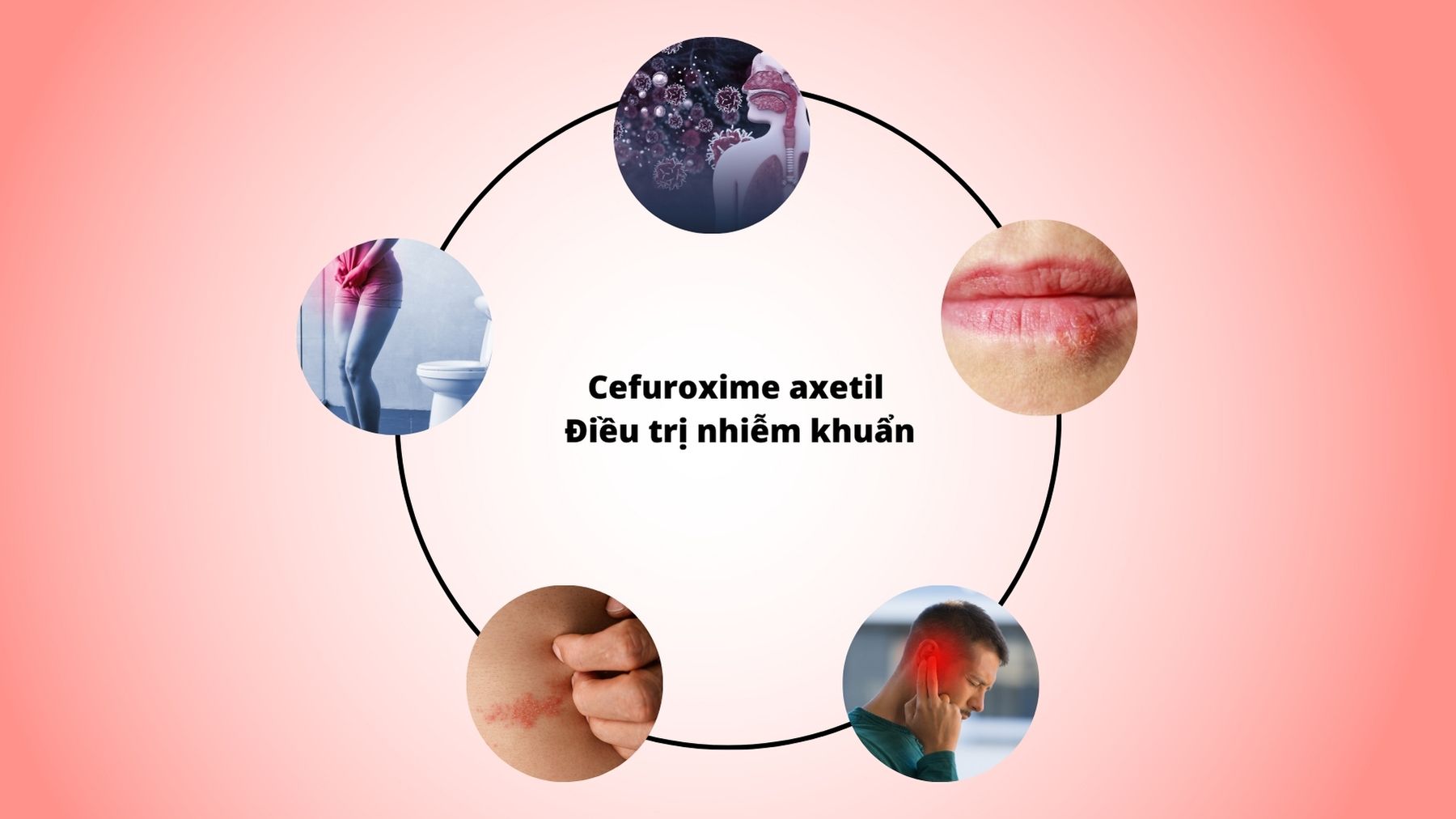 Cefuroxim l&agrave; một kh&aacute;ng sinh cephalosporin thế hệ 2 c&oacute; t&aacute;c dụng diệt khuẩn 