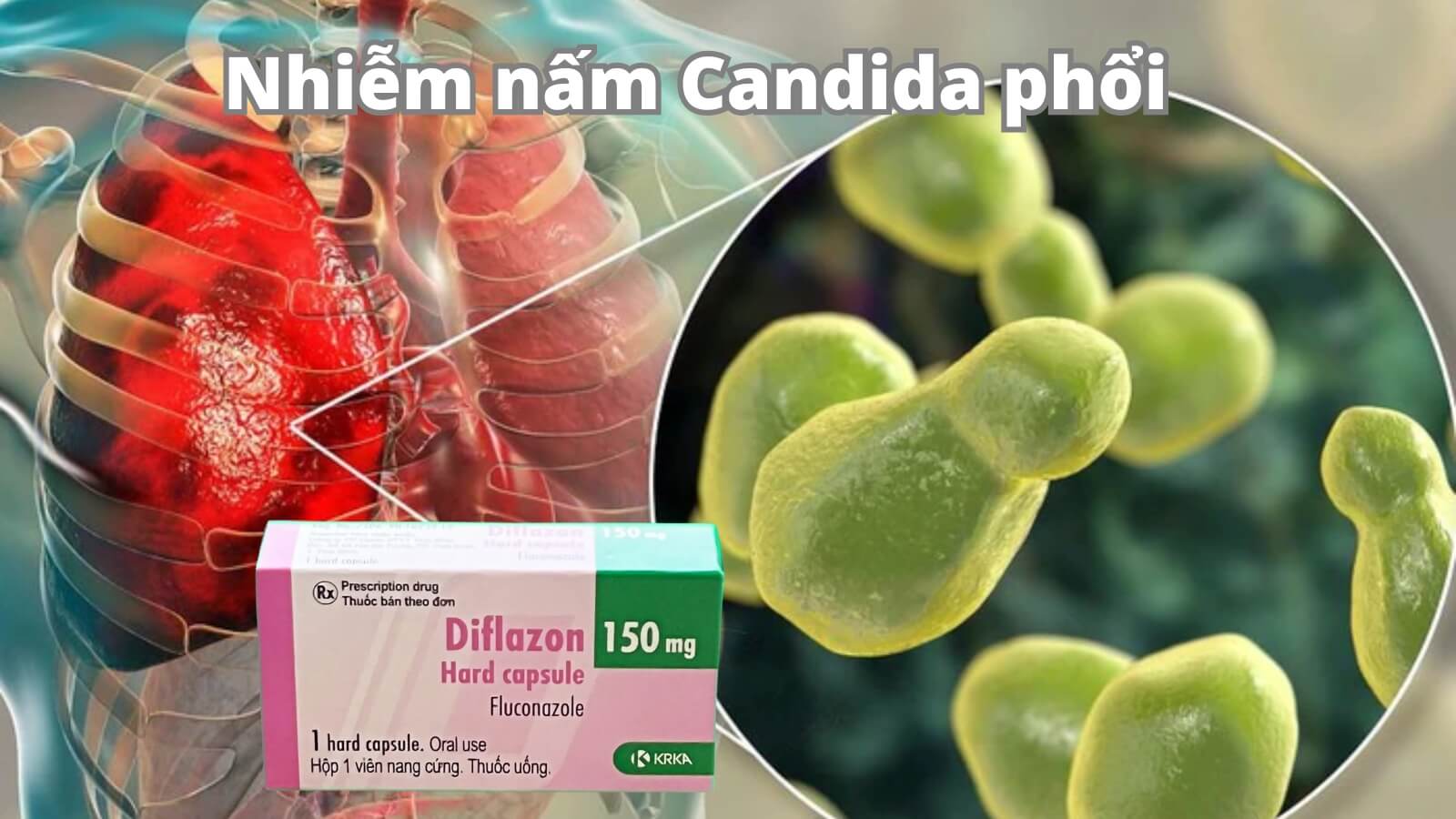Diflazon c&oacute; t&aacute;c dụng Bắn Cá HZ88 là trò chơi giải trí điện tử nấm Cadida ở phổi