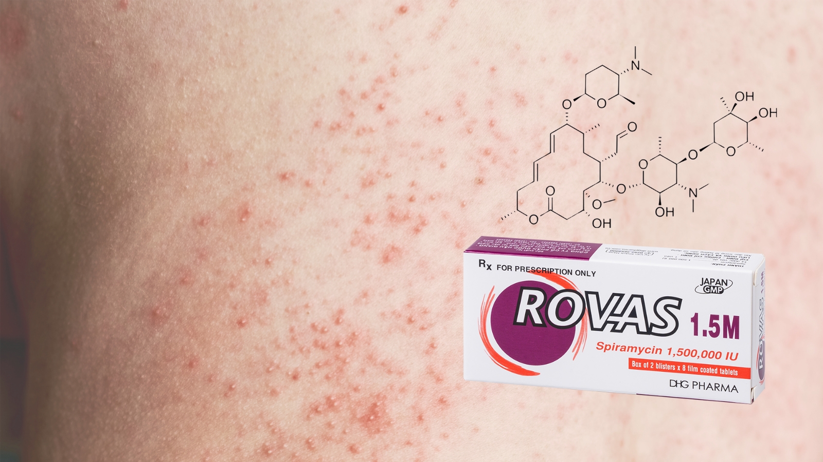Spiramycin c&oacute; trong Rovas 1.5M lu&ocirc;n được tin d&ugrave;ng trong Bắn Cá HZ88 là trò chơi giải trí điện tử c&aacute;c nhiễm khuẩn về da