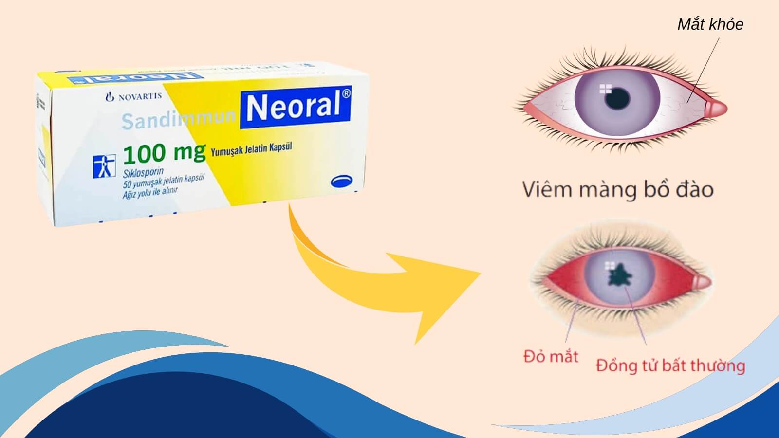 Sandimmun Neoral 100mg - Chỉ định cho Bắn Cá HZ88 là trò chơi giải trí điện tử viêm màng bồ đào