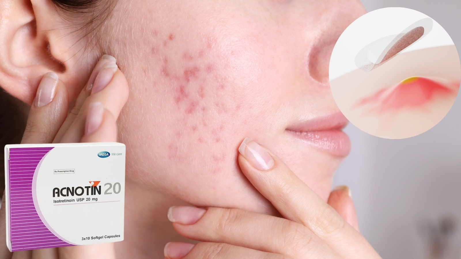Isotretinoin c&oacute; t&aacute;c dụng kh&aacute;ng vi&ecirc;m, gi&uacute;p l&agrave;m dịu c&aacute;c nốt mụn sưng đỏ.